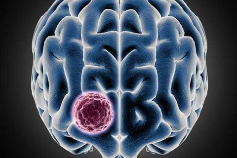 ΕΓΚΕΦΑΛΙΚΑ ΑΙΜΑΤΩΜΑΤΑ