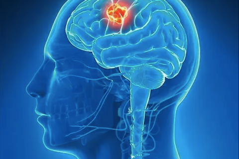 ΚΡΑΝΙΟΕΓΚΕΦΑΛΙΚΕΣ ΚΑΚΩΣΕΙΣ